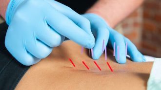 dry-needling