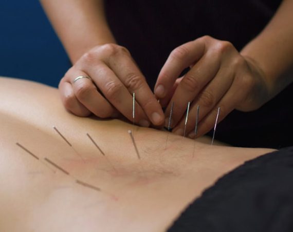 dry-needling